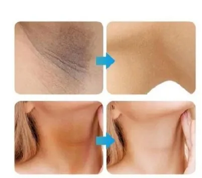 Whitening Cream for sensitive Areas underarm and private Areas - 30g